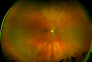 healthy-retina-california